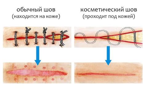 Постепенное уменьшение видимости раневых швов на коже