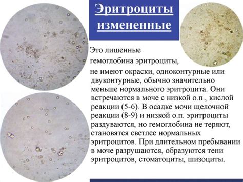 Потенциальные последствия и проблемы, вызванные наличием эпителия с плоской структурой в моче