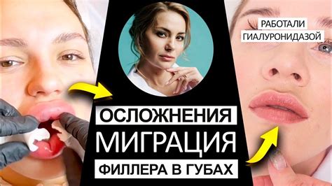 Правильный уход за кожей после инъекций филлера в зоне губно-носового треугольника