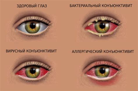 Предупреждение загноивания глаза у взрослого