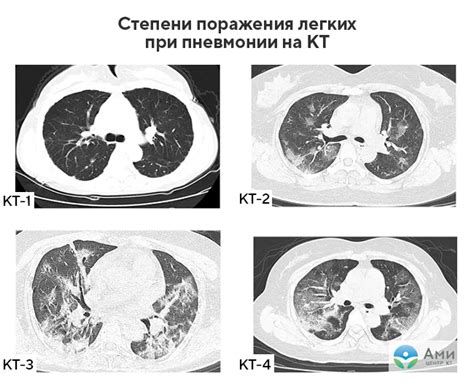 Преимущества использования матового стекла на КТ легких