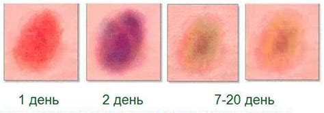 Примета №2: Отек и гематома после получения удара в область левого локтя