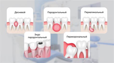 Принципиальные меры при обнаружении порванного абсцесса в десне