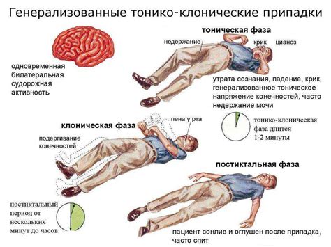 Принципы оказания первой помощи при приступе эпилепсии