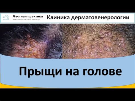 Причины возникновения гнойников на коже головы