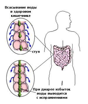 Причины возникновения диареи