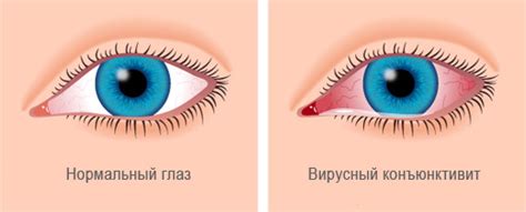Причины возникновения конъюнктивита