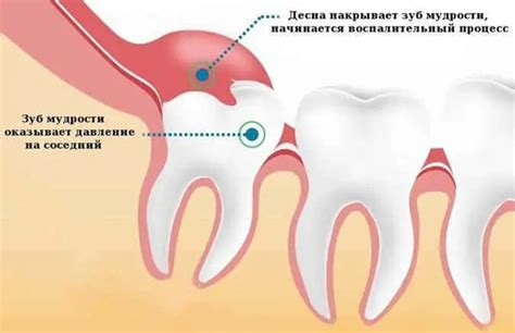 Причины гниения зуба мудрости