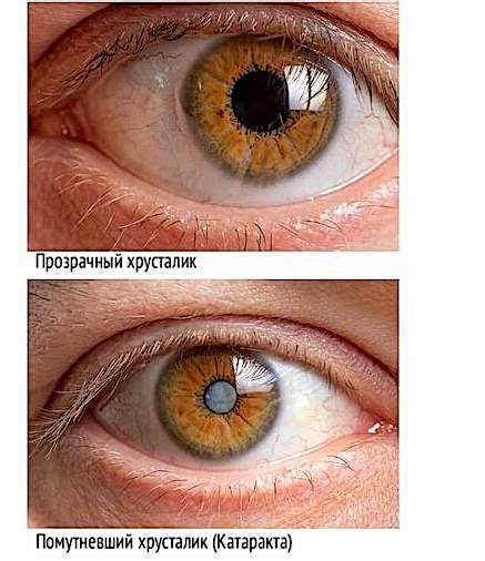 Причины и симптомы краснения глаза
