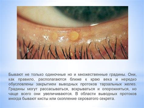Причины и способы лечения загноившегося глаза у взрослого