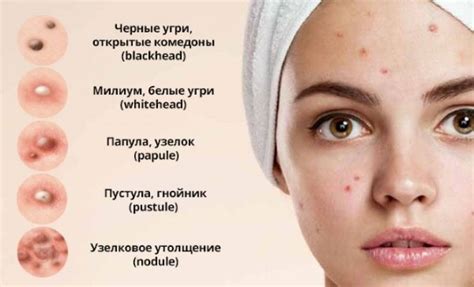 Причины и факторы риска частого появления прыщиков на коже выше локтя