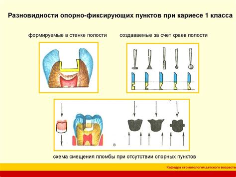 Причины образования кариозных полостей