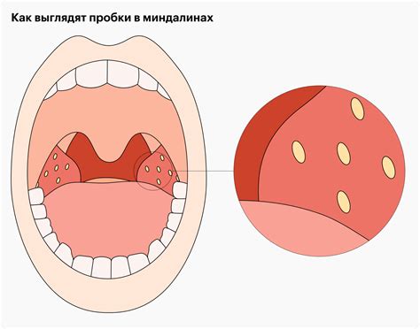Причины образования сыпучих масс в миндалинах