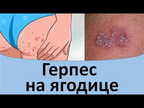 Причины появления инъекций на ягодице
