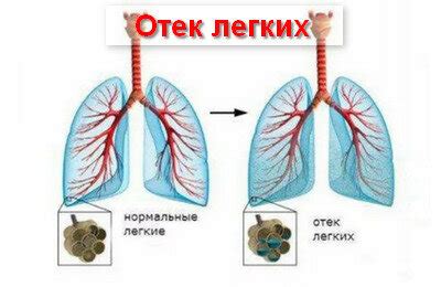 Причины развития гноя в легких