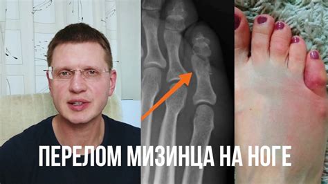 Проблема увеличения размера пятого пальца на ноге: суть проблемы