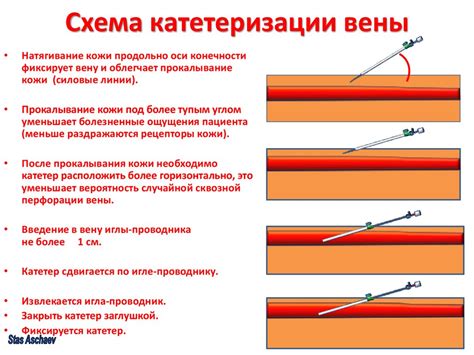 Проведение катетеризации вены