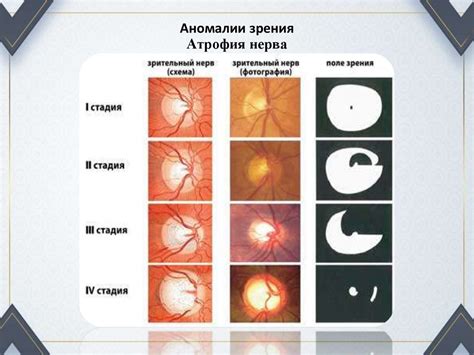 Профилактика глазных заболеваний
