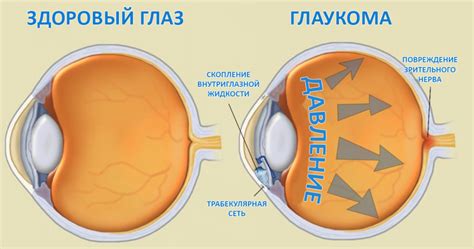 Профилактика и лечение изменений глазного давления