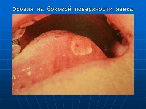 Профилактика и методы борьбы с отложениями на поверхности языка
