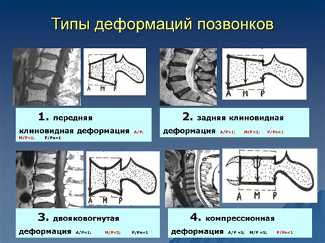 Профилактика и предотвращение возникновения характерных деформаций позвоночника у мужчин