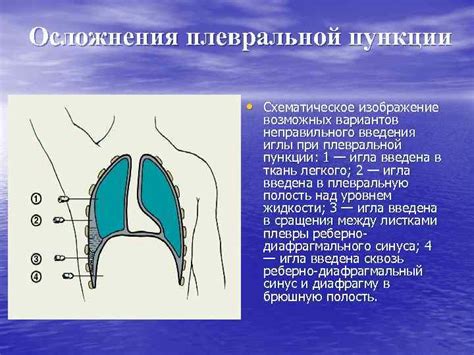 Профилактика развития двустороннего застойного копотения в плевральной полости