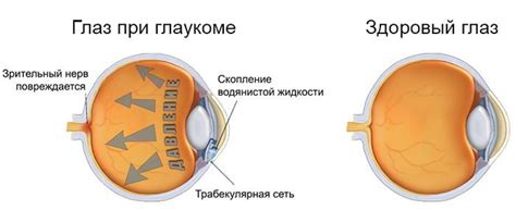 Профилактика узкоугольной глаукомы