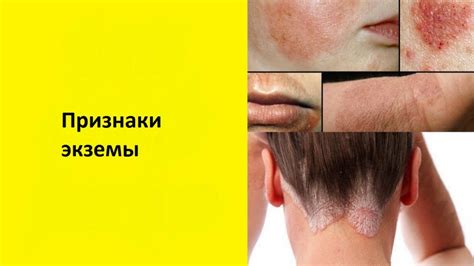 Псориаз и экзема: хронические заболевания, вызывающие отшелушивание кожи