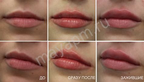 Развитие синтетических материалов: новый взгляд на увеличение объема губ