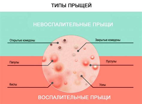 Различные виды прыщей