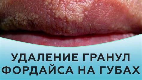 Различные методы для борьбы с проблемой гранул Фордайса