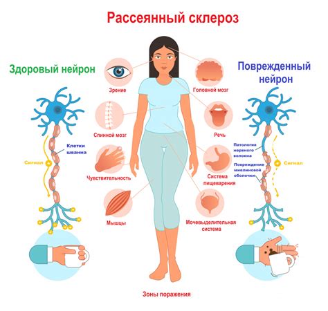 Рассеянный склероз и связь с недостатком определенных веществ