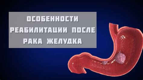 Реабилитация после лечения узкоугольной глаукомы