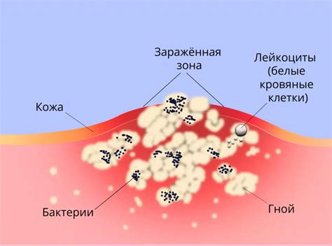 Регулярная гигиена и профилактика для предотвращения гнойных инфекций на десне