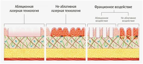 Рекомендации для успешной проведения лазерного воздействия на шрамы