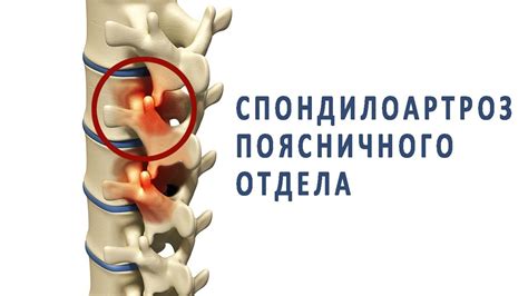 Рекомендации для устранения дефекта поясничного отдела позвоночника