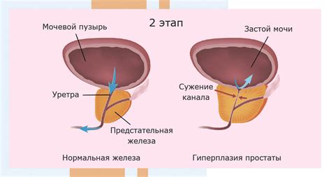 Рекомендуемая частота и продолжительность сеансов массажа предстательной железы