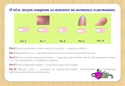 Рецепты при различных проблемах ногтевой пластины: сольные ванночки