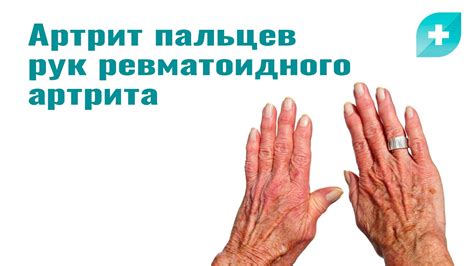 Риск возникновения артрита