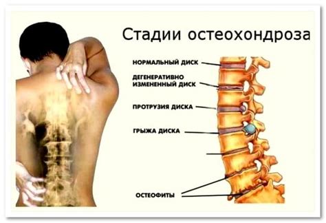 Связь головокружения с заболеваниями: гипотония, остеохондроз, мигрень и другие