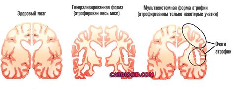 Симптомы глобальной кортикальной атрофии мозга