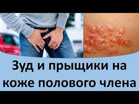 Симптомы гнойничков