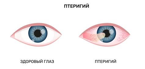 Симптомы затягивания глаза