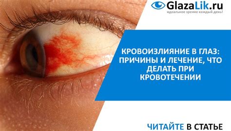 Симптомы и возможные причины кровоизлияния в глаза