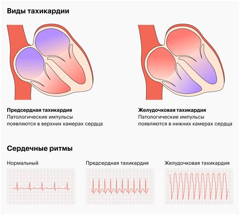 Симптомы и потенциальные последствия повышенного пульса в состоянии покоя