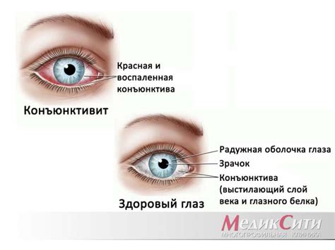 Симптомы коньюктивита