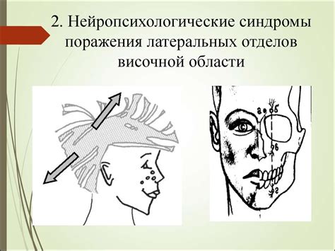 Симптомы поражения в височной области