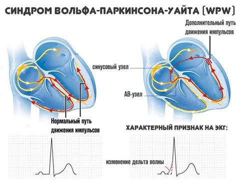 Синдром WPW: особенности, проявления и методы лечения