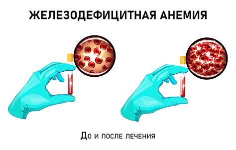 Скрытый угроза: железодефицитная анемия и ее влияние на организм