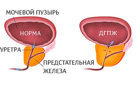 Современные подходы к диагностике и лечению опухоли предстательной железы у мужчин